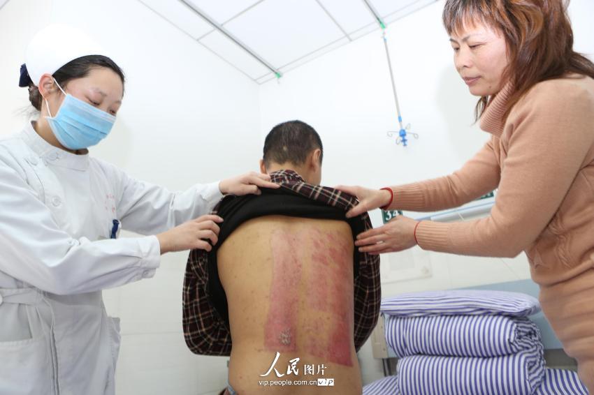 3��23�գ����к���ҵ������ҽԺ���˿Ʋ����������������Ϊ����ֲƤ�����µĴ��̺ۡ�
