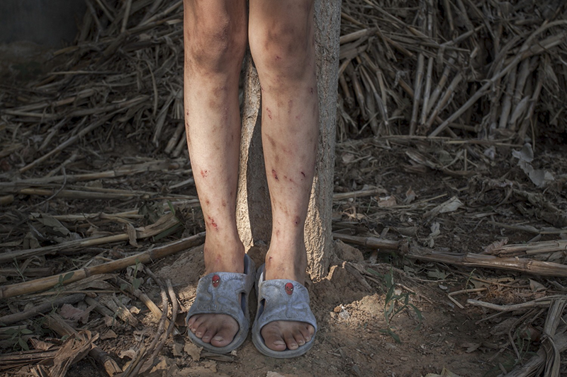 2008年7月2日,一个小伙伴腿上被蚊虫叮咬的伤痕累累,夏季村里蚊虫多.